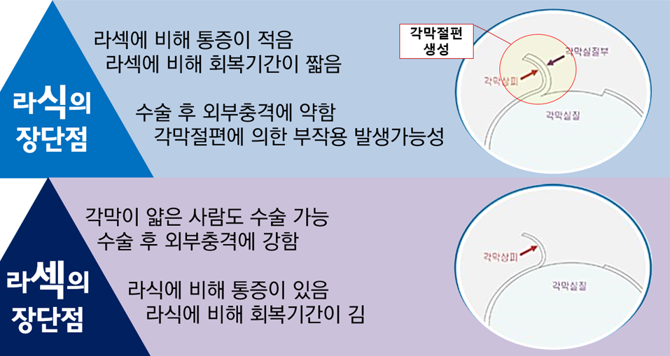 라식수술과 라섹수술의 차이점 | 인스티즈