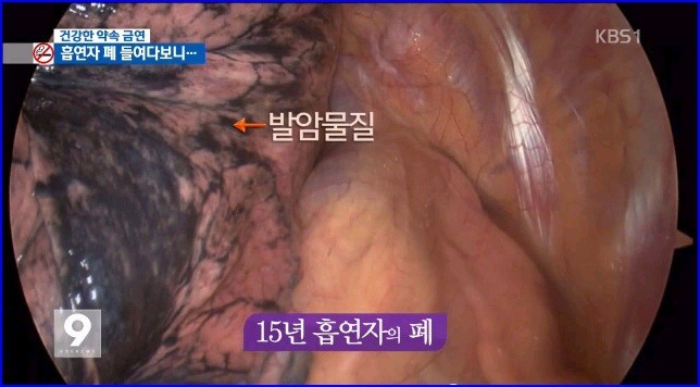 흡연자의 폐 | 인스티즈