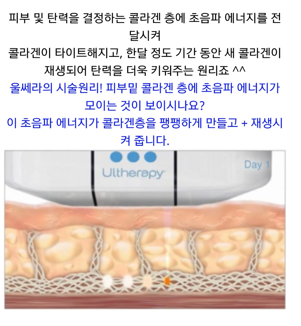 리프팅 부작용에 대해 아는 사람 있어? 혼자 알기 싫어서 찌는 글 | 인스티즈