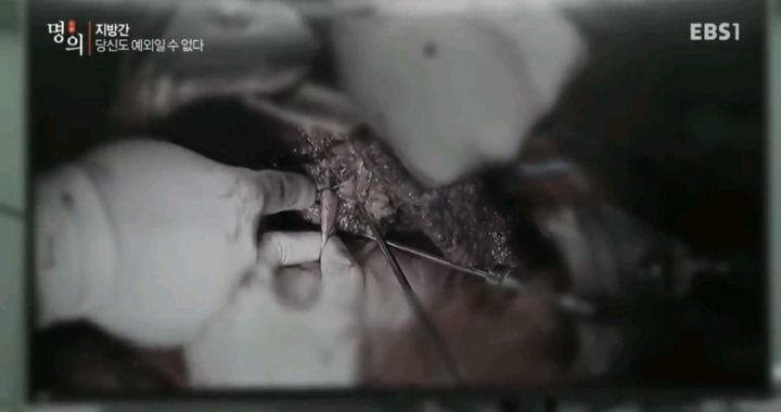 말기 간경변 환자의 간.jpg (사진주의) | 인스티즈