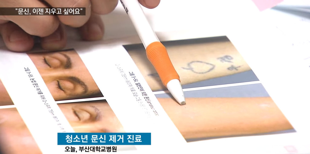 문신, 이제 지우고 싶어요! | 인스티즈